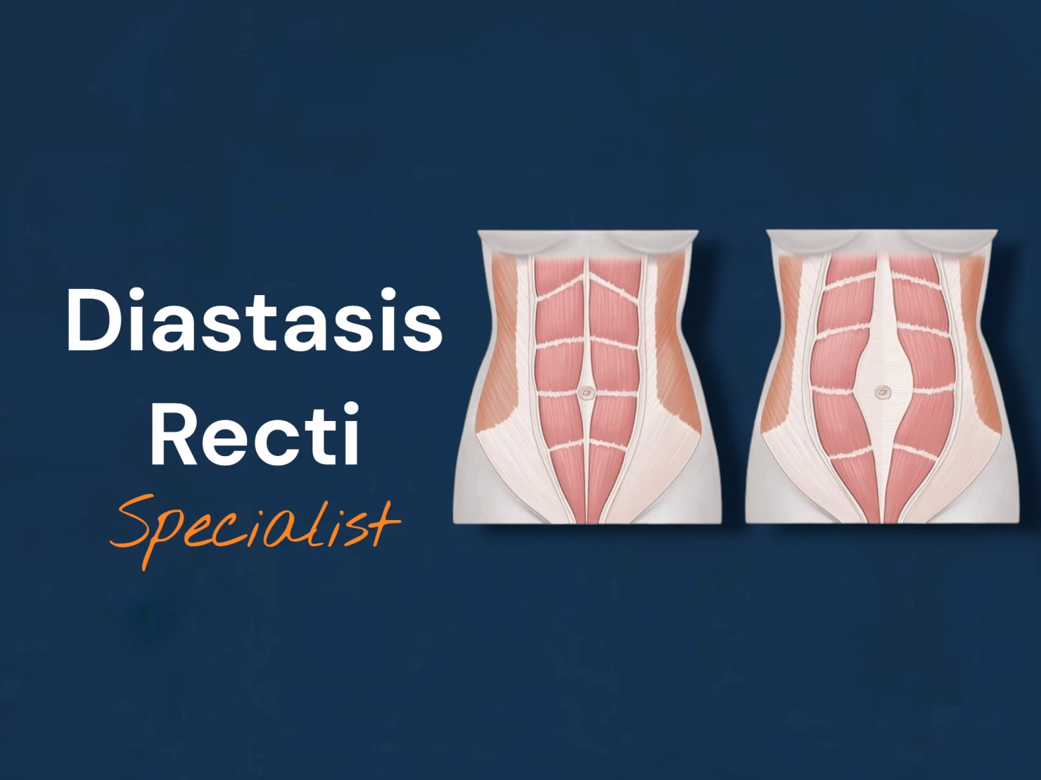Diastasis Recti Specialist 